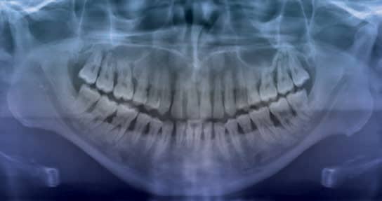 moderate periodontitis radiograph