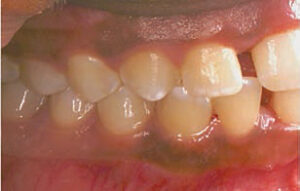 FIGURE 3. The right quadrants of the patient from Figure 2 before undergoing periodontal treatment.