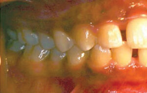 FIGURE 5. The upper right quadrant two years after periodontal treatment.