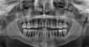 FIGURE 7. A panoramic radiograph shows full dentition with generalized severe bone loss and some subgingival etiology.