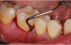 FIGURE 9. Tooth #30 mesial-buccal with a 12 mm probing depth pretreatment.