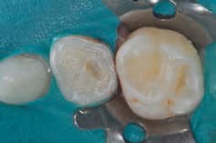 FIGURE 3. When placing stainless steel crowns, the occlusal surface is reduced to allow space for the crown and cement. This reduction should follow the surface’s original contour.