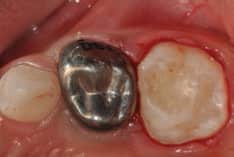 FIGURE 5. As is the case here, glass ionomer is commonly used to cement stainless steel crowns.