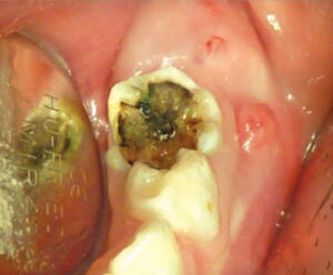 FIGURE 1. A sinus tract is associated with tooth #K, which also exhibits deep caries.