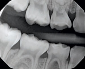 FIGURE 3. This image of tooth #S shows furcation radiolucency.