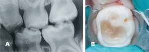 FIGURE 5A and 5B. Tooth #K with deep caries was treated with indirect pulp treatment. The discolored, affected dentin is left behind to avoid pulpal exposure.