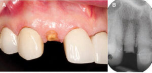 FIGURE 1A and FIGURE 1B. Preoperative clinical photo (A). Periapical X-ray prior to extraction of #7 (B).