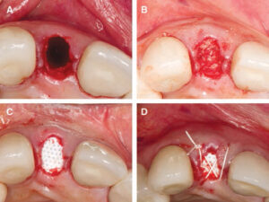 FIGURES 2A through 2D. Minimally invasive extraction (A). Placement of bone allograft into intact extraction socket (B). Space creation (i.e., tunneling) for d-PTFE membrane placement (C). Stabilization of biomaterials by suturing using e-PTFE sutures (D).