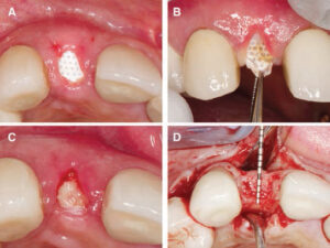 FIGURES 3A through 3D. Postoperative photo at two weeks (A). Removal of d- PTFE membrane (B). Post-membrane removal at four weeks (C). Adequate alveolar ridge five months after socket augmentation (D).
