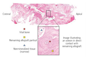 FIGURE 4. Histologic evidence from core sample after a socket augmentation procedure — using d-PTFE — illustrating vital bone formation.