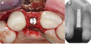 FIGURE 5A and FIGURE 5B. Implant placement in grafted alveolar ridge after five months (A). Periapical X-ray showing adequate implant positioning (B).