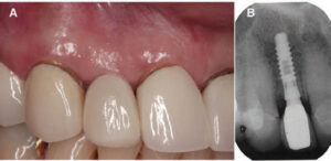 FIGURE 6A and FIGURE 6B. Six months after implant rehabilitation with screwretained single crown (A). Radiographic view (B).