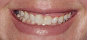 FIGURE 1A. A preoperative view reveals a 34-year-old woman’s localized gummy smile and asymmetrical gingival display.