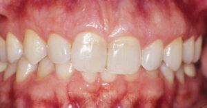 Correcting Excess Gingival Display - Decisions in Dentistry