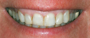 FIGURE 2. This 45-year-old female presented with generalized excess gingival display, asymmetric gingival margins and short clinical crowns.