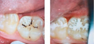 FIGURE 2. This series depicts the placement of glass ionomer cement sealant following caries arrest with silver diamine fluoride (SDF), eight weeks post-SDF application.