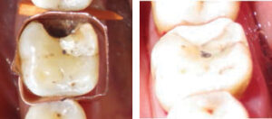 FIGURE 3. As seen here, a glass ionomer restoration is placed immediately after applying silver diamine fluoride (SDF). The marking in the central pit is articulating paper, not SDF.