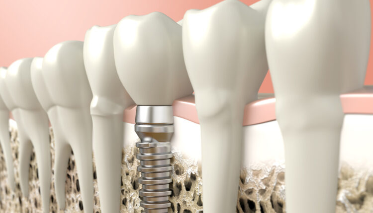 assessing-survival-rates-of-zirconia-dental-implants