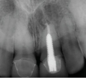 root-canal-fig-5a