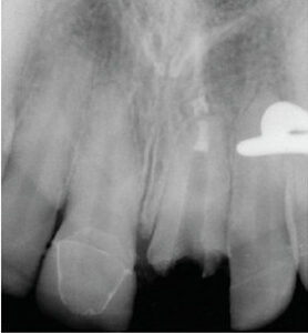 root-canal-fig-5b