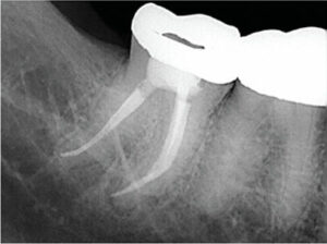 FIGURE 3B.Endodontic retreatment provides a meaningful benefit to the patient.