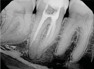 FIGURE 4. Poorly rendered therapy and a distal root perforation led to a devastating overfill in the mandibular canal.