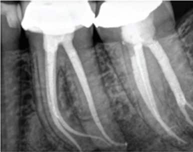 root-canals-fig-1