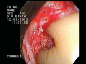 FIGURE 7. After calculus is removed, the root surface is often treated with a root conditioning agent to remove any residual thin sheets of calculus.