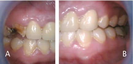 meth before and after pictures teeth