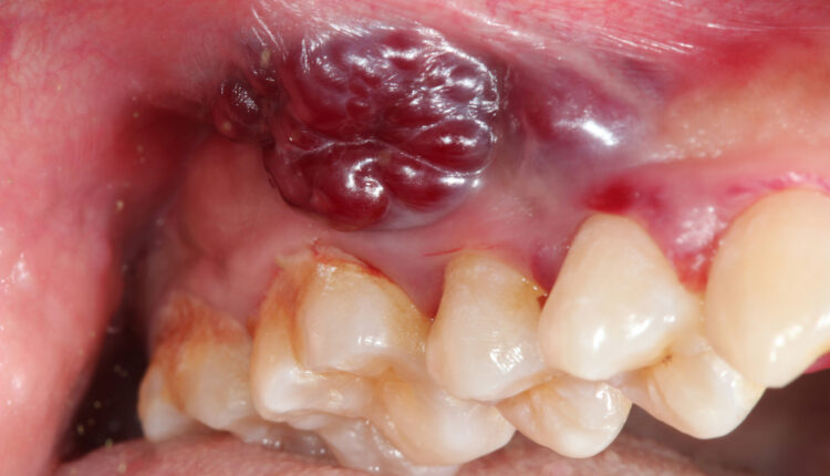 Oral Kaposi’s sarcoma.