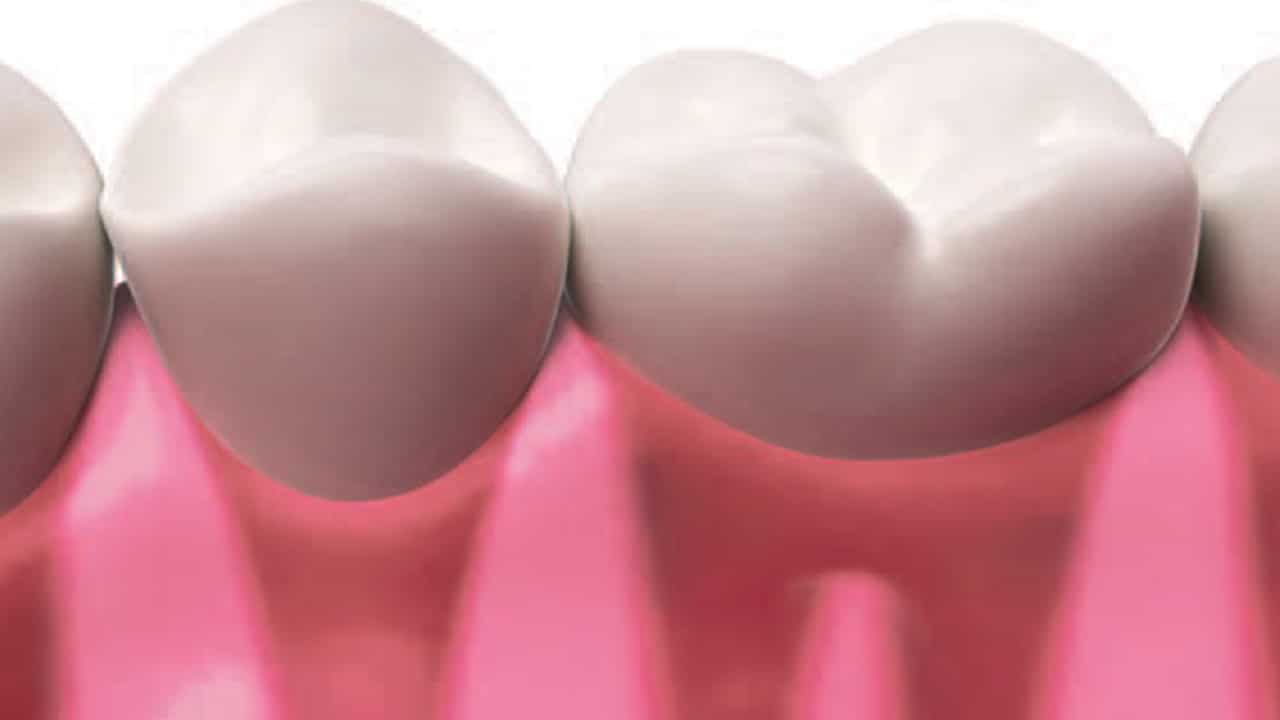 subgingival calculus