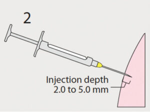 FIGURE 2. During the first injection, 0.3 to 0.5 ml of anesthetic is deposited at a depth of 2.0 to 5.0 mm. Photo courtesy of JON FRAZE