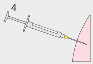 FIGURE 4. The second injection is completed using the same entry point. Photo courtesy of JON FRAZE