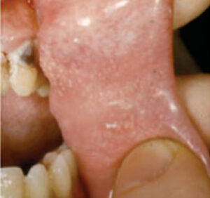 FIGURE 1. Fordyce granules in the buccal mucosa are seen here.