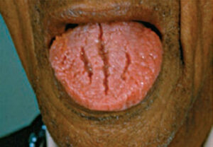 FIGURE 2. Squamous cell carcinoma can develop in the fissures that accompany scrotal tongue.