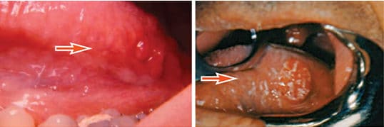 FIGURE 3A. The granular appearance of lingual tonsil often leads to a mistaken malignant diagnosis.FIGURE 3B. This is an example of squamous cell carcinoma located in lingual tonsil tissue.