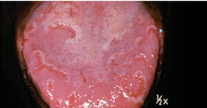  Also known as geographic tongue, benign migratory glossitis presents with a map-like appearance.