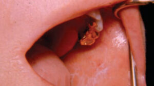 FIGURE 5. This image depicts reticular lichen planus of the buccal mucosa.