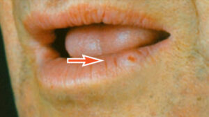 FIGURE 6. This patient presented with squamous cell carcinoma of the lip.