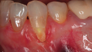 considerations procedures graft pedicle decontamination rotational recession