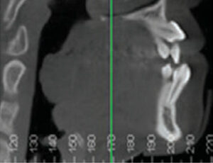 FIGURE 4A. Cone beam computed tomography: right side, pretreatment.