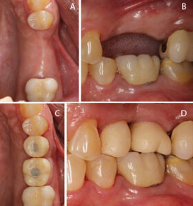 FIGURES 13A through 13D. These images of the maxillary left posterior region depict the initial presentation prior to surgery, and seven months postoperative with provisional implant crowns on #13 and #14 that were fabricated by the restorative dentist six months postsurgically.