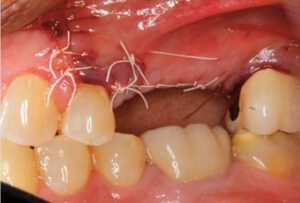 FIGURE 10. This image shows the surgical area following suturing.