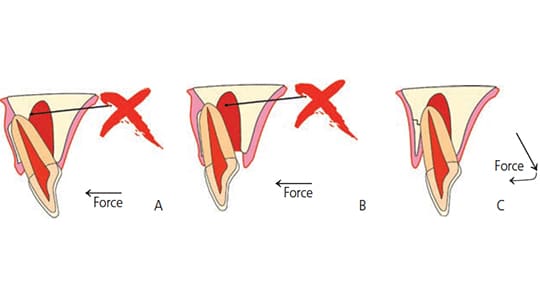 tooth luxation