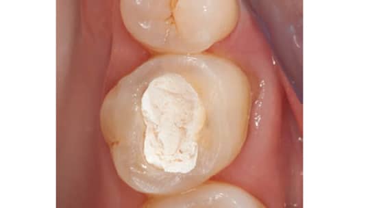 Fiber-reinforced restoration of a structurally compromised tooth