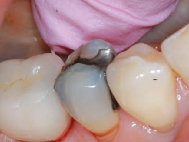 Managing Implant Complications course image