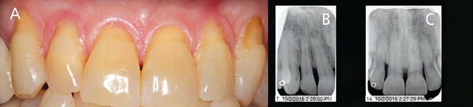 Diagnosis And Treatment Of Gingival Recession Decisions In Dentistry