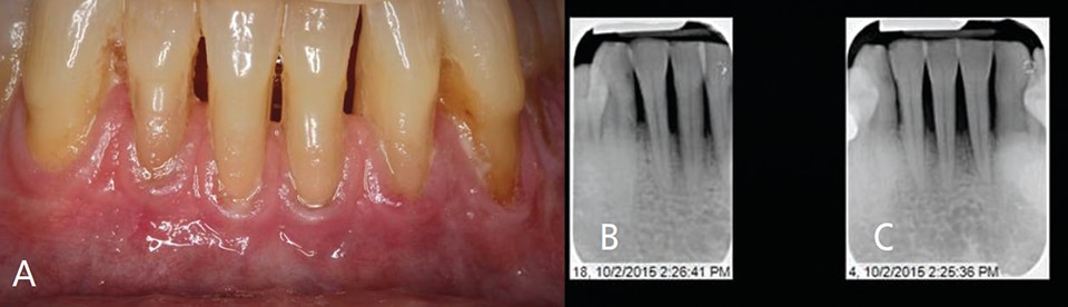 Diagnosis And Treatment Of Gingival Recession Decisions In Dentistry 