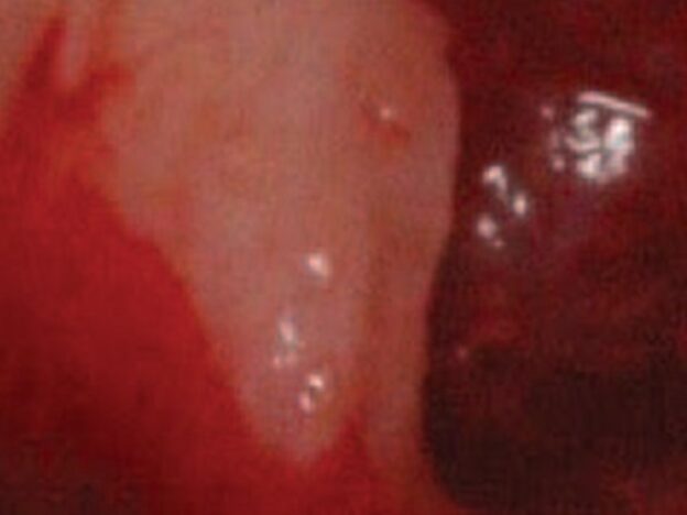 Impact of Septa During Bone Augmentation in the Maxillary Sinus course image