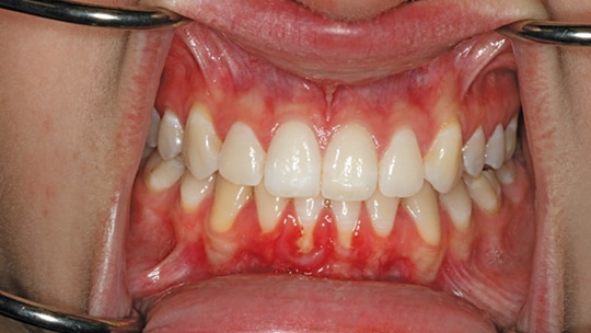 Diagnosis And Treatment Of Gingival Recession Decisions In Dentistry